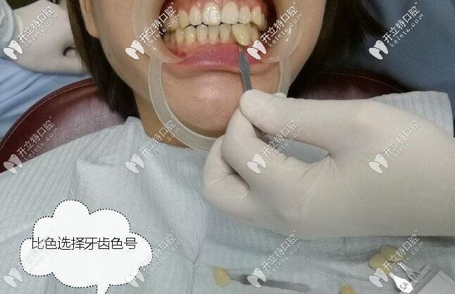 西安畫美團圓口腔皓齒美白案例