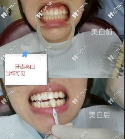 皓齒美白前后對比 西安畫美團圓口腔門診部
