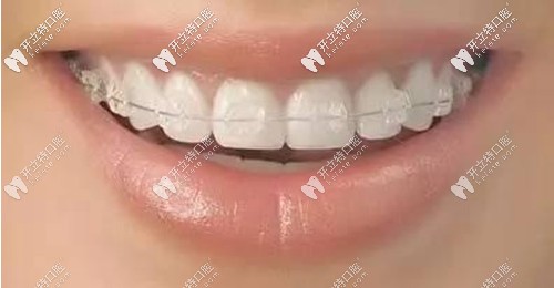 什么是陶瓷半隱形牙齒矯正