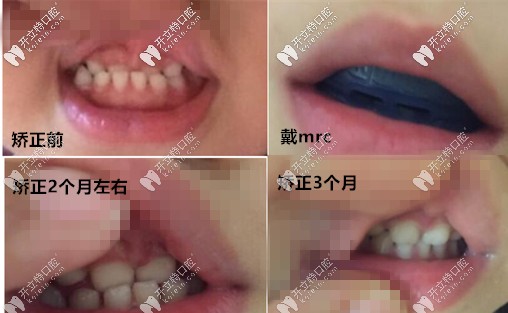 mrc矯正真人案例