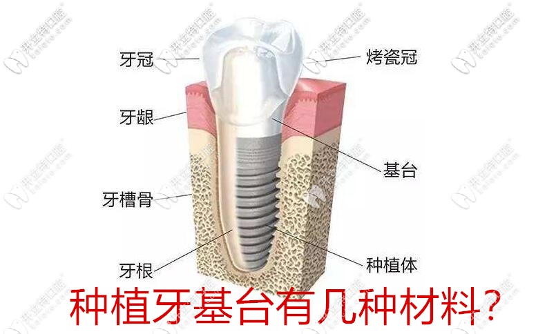 種植牙基臺有幾種材料?文中有種植牙基臺種類圖的大介紹喲