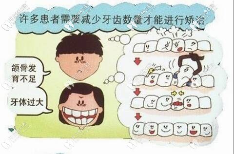 自鎖托槽矯正可以免除拔牙