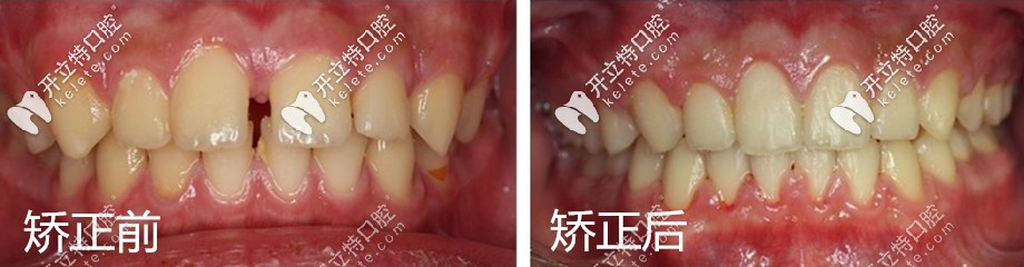 做牙齒矯正的前后對比圖