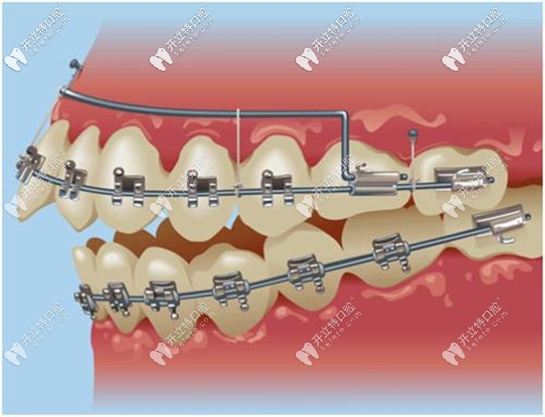 金屬自鎖托槽牙齒矯正優(yōu)惠價格