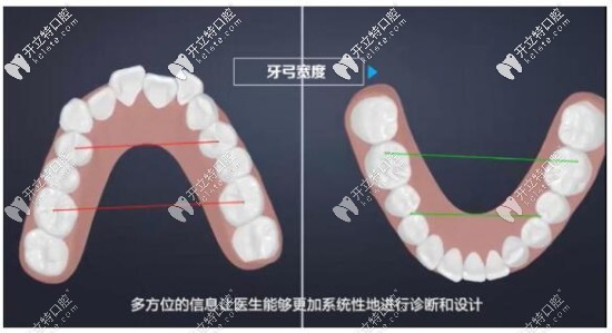 數(shù)字化牙齒矯正優(yōu)惠價格