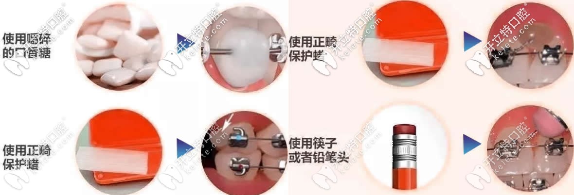 戴金屬托槽牙套結扎絲脫出的解決方法