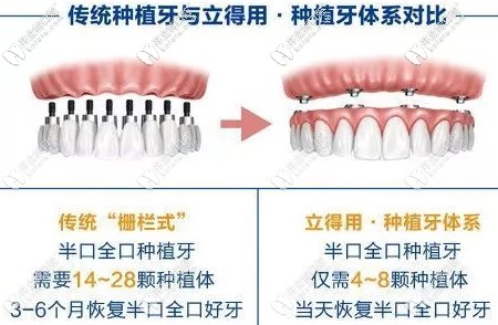 傳統(tǒng)種植牙與立得用種植牙區(qū)別