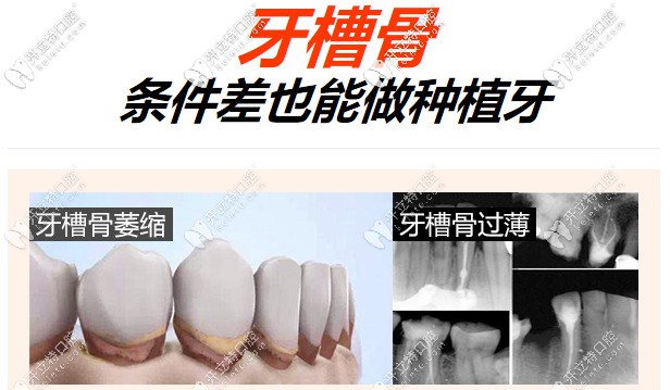 牙槽骨條件差也可以做種植牙