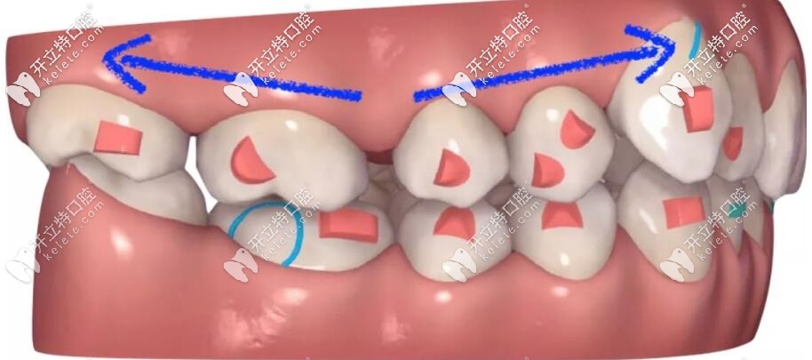 隱適美矯治器磨牙后推示意圖