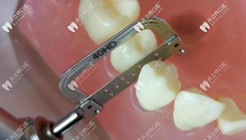 正畸磨牙圖片