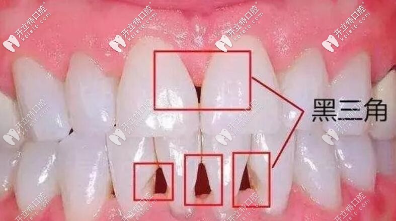 牙齒黑三角