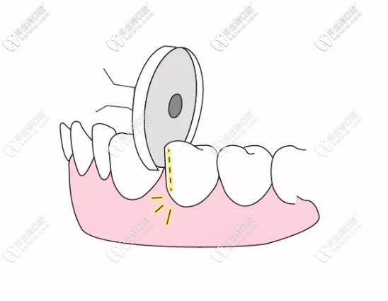 漲姿勢：片切和拔牙的利弊你真的清楚嗎？
