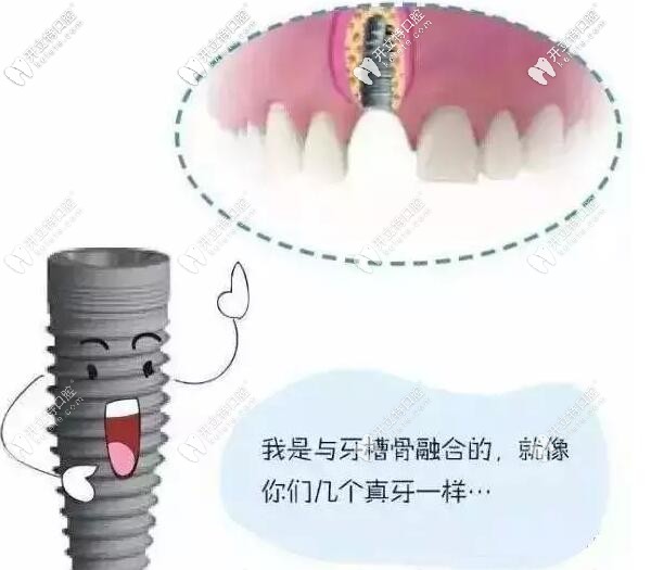 種植牙選對(duì)種植體愈合很快