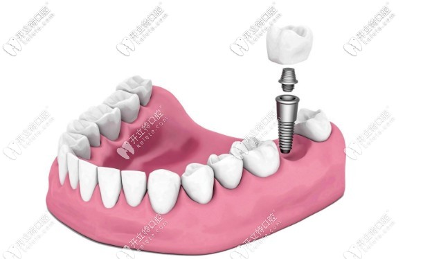 種植牙一期手術(shù)完成 種植牙一期手術(shù)完成