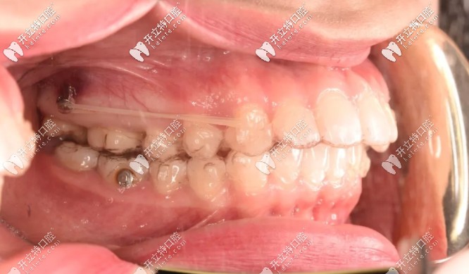 打了骨釘后的圖片 打了骨釘后的圖片