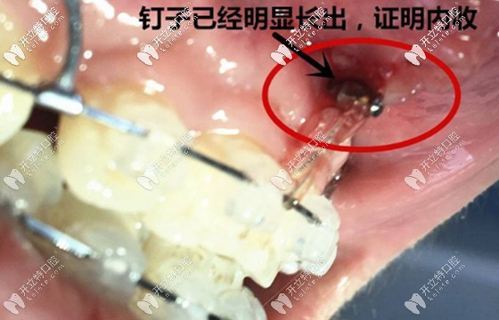 支抗釘?shù)氖姑瓿删鸵∠聛?lái)了