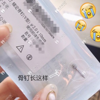 剛拿到骨釘?shù)膱D片 剛拿到骨釘?shù)膱D片