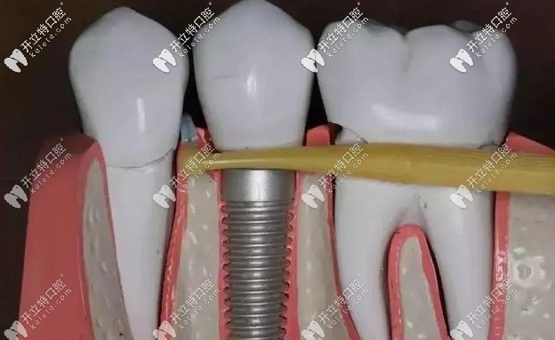 種植牙崩瓷怎么辦 種植牙崩瓷怎么辦