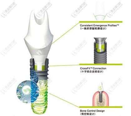 高端品牌的瑞士iti種植體圖解