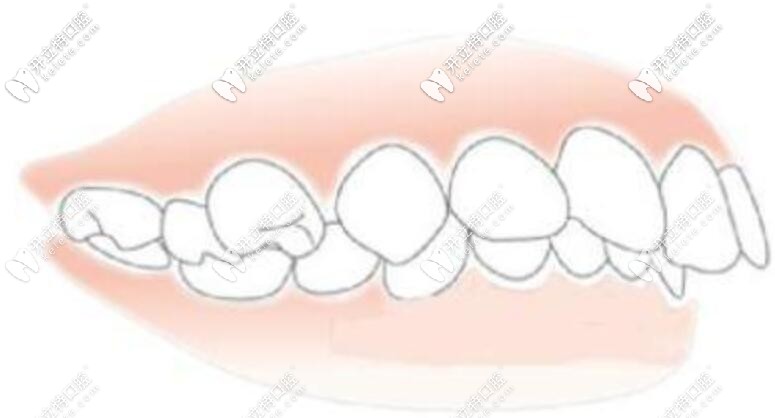 高角型深覆合圖片