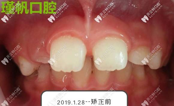 兒童矯正前的牙齒正面照