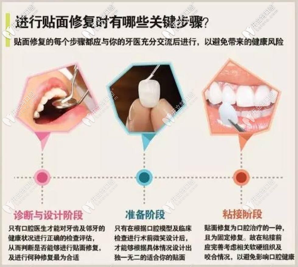 做牙齒貼面設(shè)計要點
