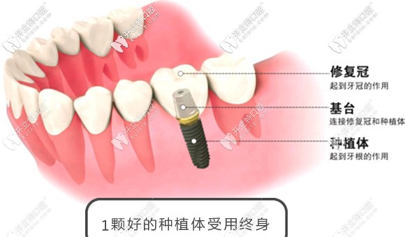 韓國(guó)奧齒泰種植體+烤瓷冠才3980元起
