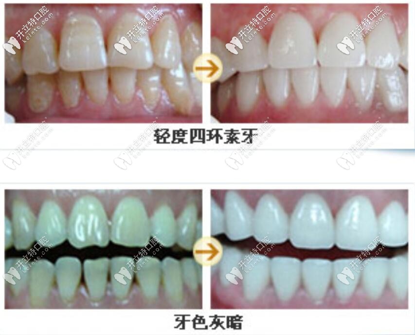 瓷貼面前后對比