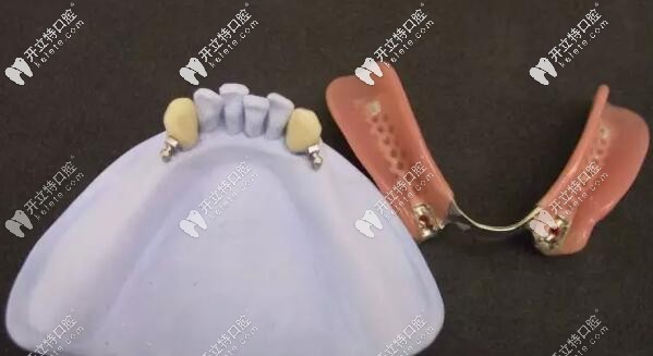 栓道式精密附著體義齒