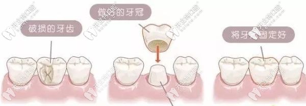 解答：門(mén)牙缺了一小塊是選牙齒貼面還是全瓷牙好呢？