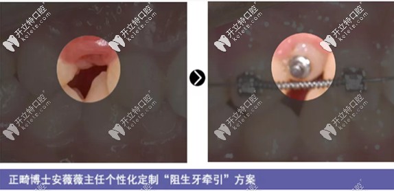 12歲孩子的阻生牙牽引加正畸案例