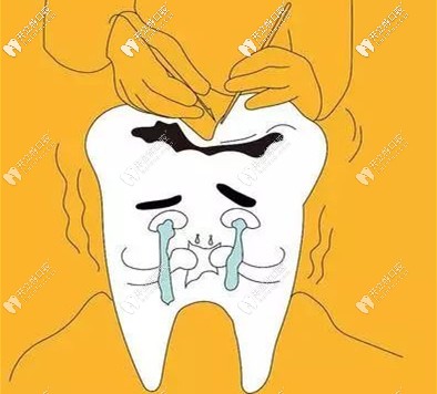 想要做一次性根管治療需要醫(yī)生技術(shù)精細