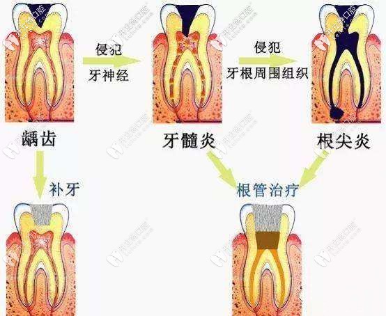 根管治療示意圖