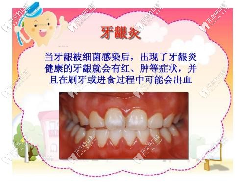 牙齦炎癥狀介紹