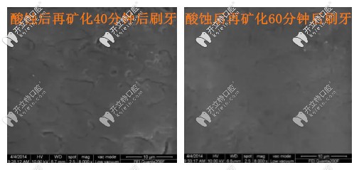 酸蝕再礦化多久后再刷牙