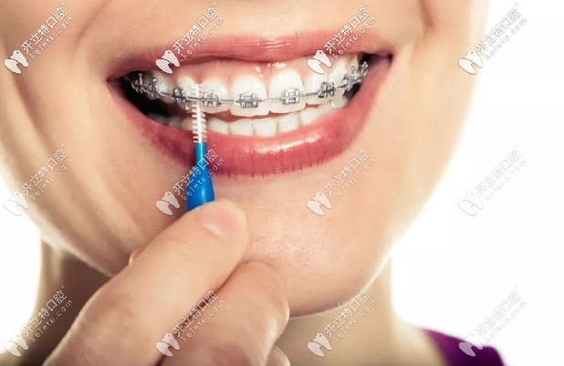 普通金屬托槽牙套