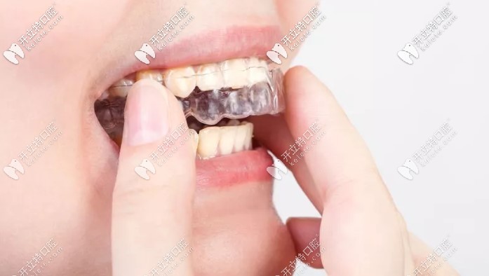 全隱形牙套圖片