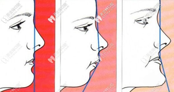 是否需要做正頜取決于多種因素