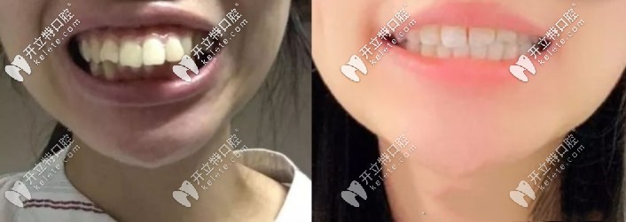 隱適美矯正齙牙前后對比照 隱適美矯正齙牙前后對比照
