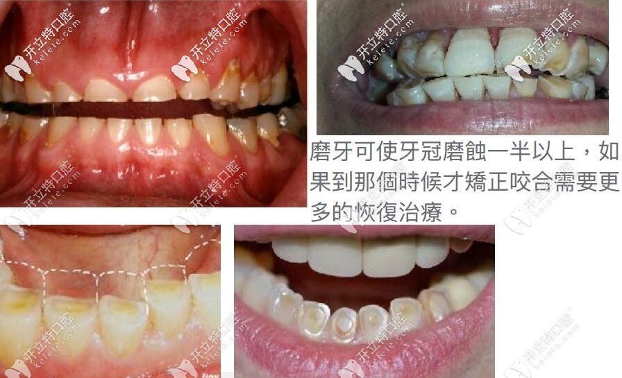 牙齒咬合不齊要及時(shí)矯正