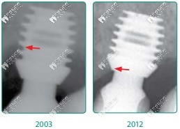 百康種植體不會(huì)出現(xiàn)骨吸收情況