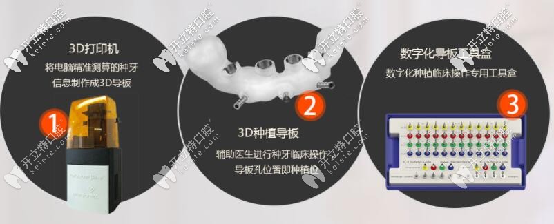 3d導(dǎo)板種植牙優(yōu)勢