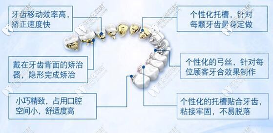 舌側(cè)隱形和唇側(cè)矯正的價(jià)格
