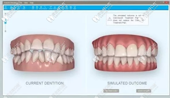 采用隱形矯正術(shù)前就可預(yù)見矯正效果 采用隱形矯正術(shù)前就可預(yù)見矯正效果