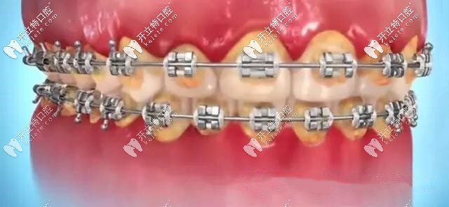 不認(rèn)真刷牙