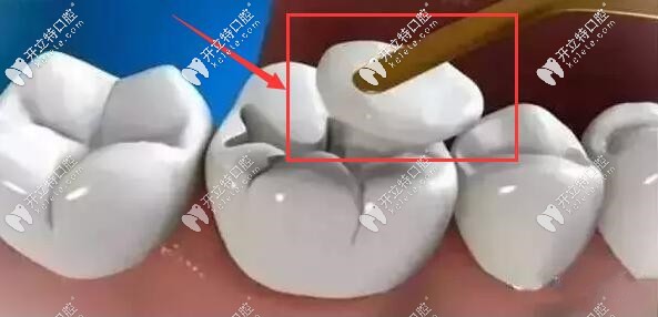 補牙材料的大小不合適