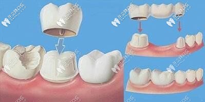 深圳嵐世紀(jì)全瓷牙冠效果圖