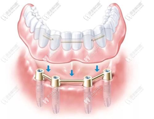 All-on-4全口種植牙示意圖 All-on-4全口種植牙示意圖