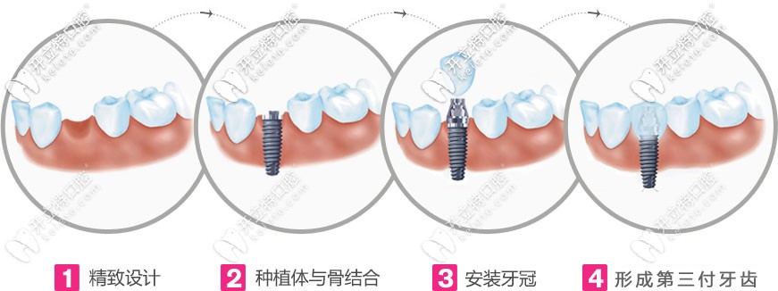 缺失1顆牙用種植牙修復(fù)