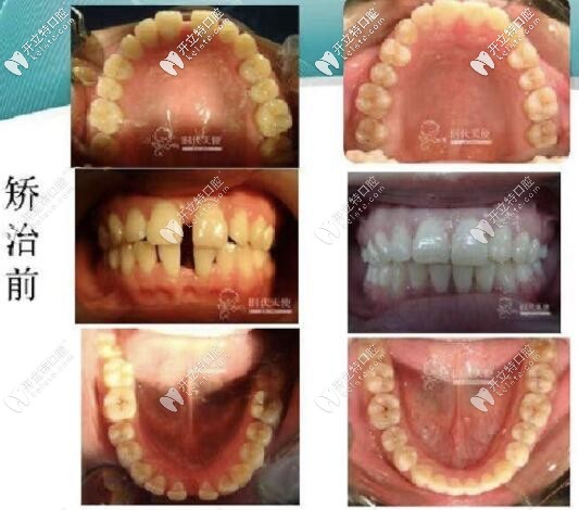 北京勁松口腔時(shí)代天使牙套案例 北京勁松口腔時(shí)代天使牙套案例